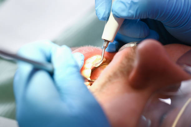 Best Emergency Root Canal Treatment in Parchment, MI